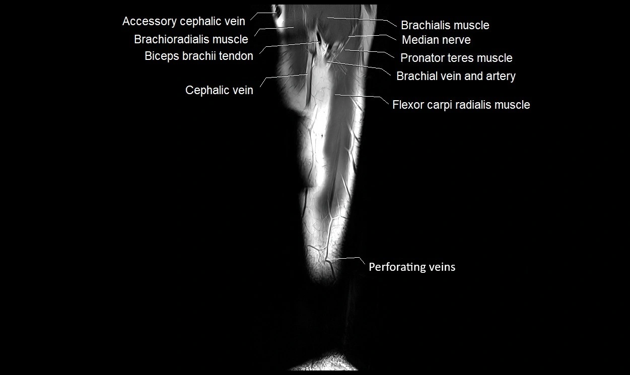 MRI 3T forearm coronal cross sectional anatomy image 4.webp